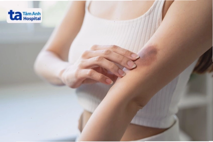 Hình ảnh minh họa vết bầm tím trên da