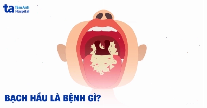 Hình ảnh minh họa vi khuẩn gây bệnh bạch hầu dưới kính hiển vi