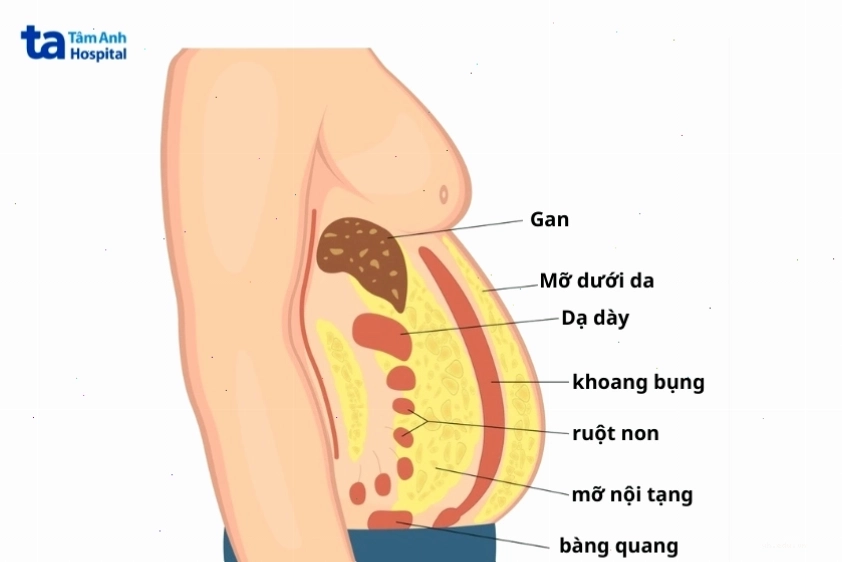 Hình ảnh minh họa vị trí tích tụ mỡ nội tạng trong khoang bụng