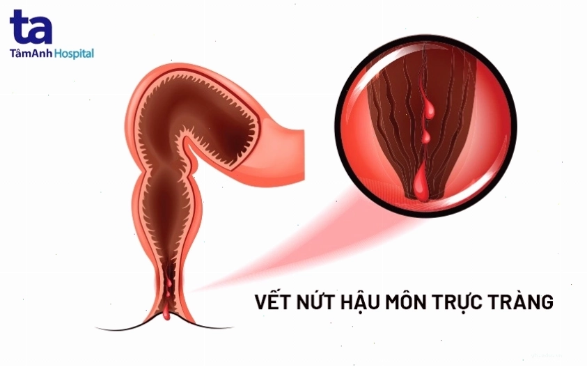 Hình ảnh minh họa vị trí và cơ chế hình thành vết nứt tại niêm mạc hậu môn