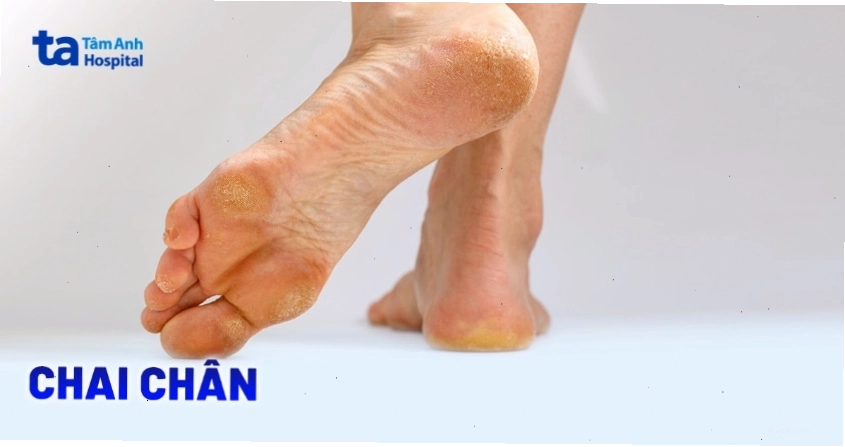 Hình ảnh minh họa vùng da chai cứng ở bàn chân