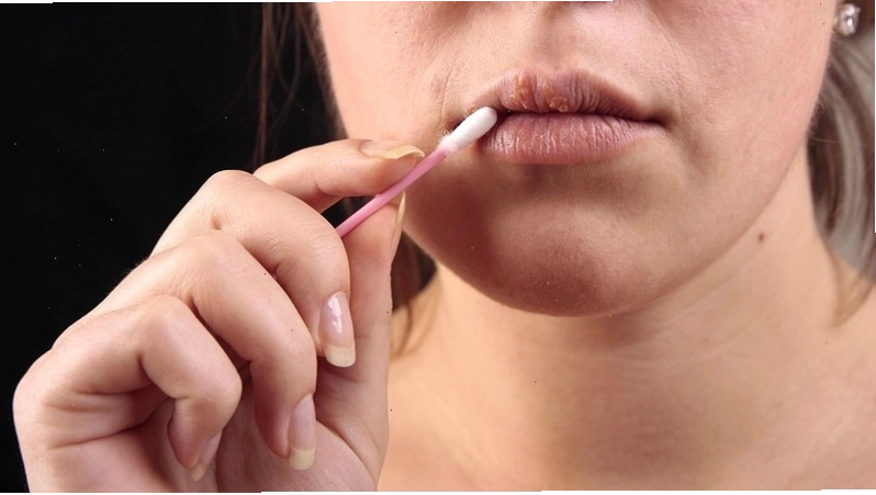 Hình ảnh minh họa vùng môi bị sưng và tê bì
