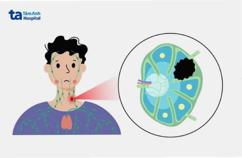 Hình ảnh mô phỏng cấu trúc hệ bạch huyết bị tổn thương bởi các tế bào lymphoma
