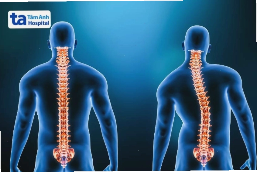 Hình ảnh mô phỏng chứng cong vẹo cột sống