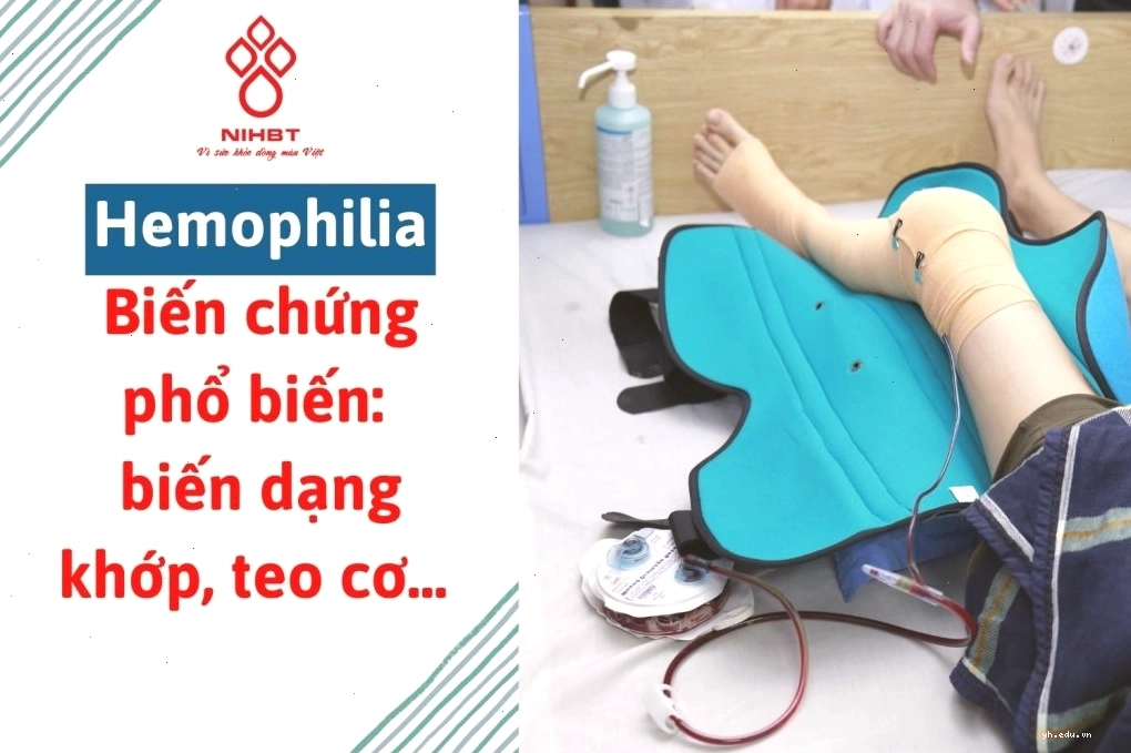 Hình ảnh mô phỏng hiện tượng chảy máu trong cơ và khớp ở bệnh nhân Hemophilia