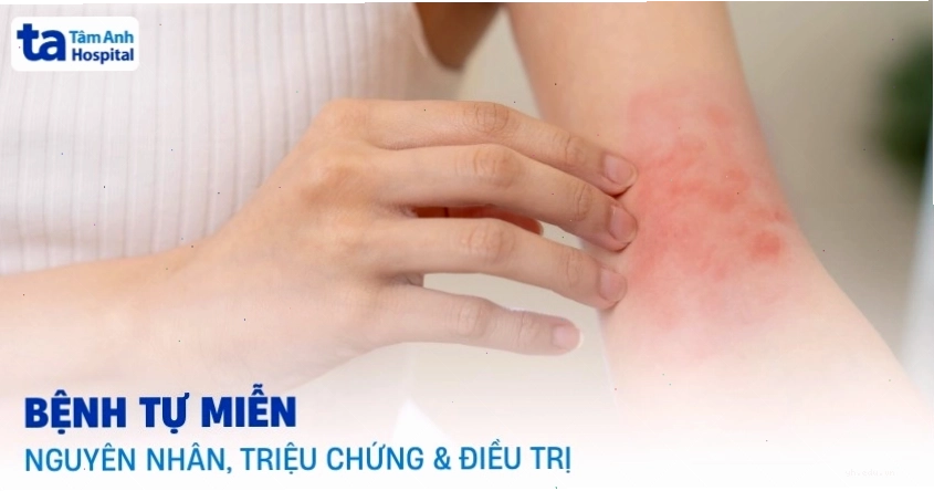 Hình ảnh mô phỏng khái niệm bệnh tự miễn trong cơ thể con người