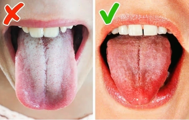 Hình ảnh mô phỏng nấm miệng do trào ngược dạ dày thực quản