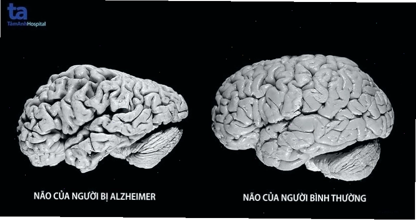 Hình ảnh mô phỏng não bộ bệnh nhân Alzheimer