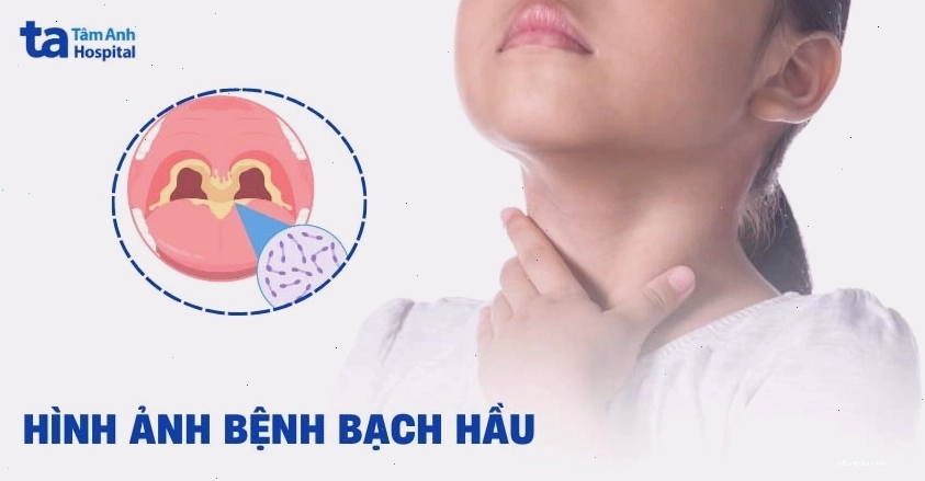 Hình ảnh mô phỏng tổn thương niêm mạc do vi khuẩn
