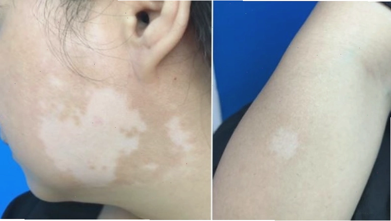 Hình ảnh mô phỏng vết da loang lổ 3
