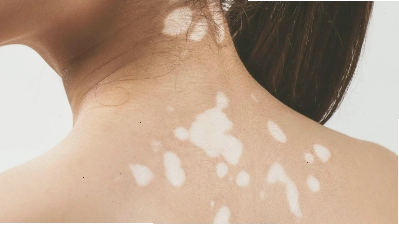 Hình ảnh mô phỏng vết da loang lổ 4