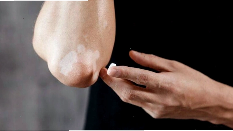 Hình ảnh mô phỏng vết da loang lổ 5