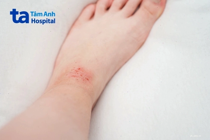 Hình ảnh mô tả bệnh viêm da cơ địa