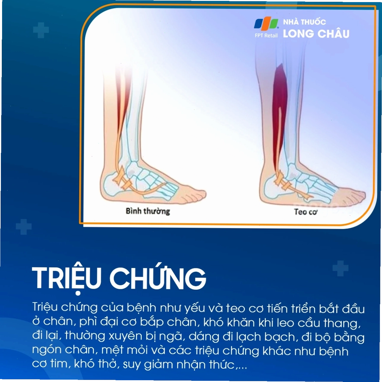 Hình ảnh mô tả cơ chế di truyền bệnh duchenne 2