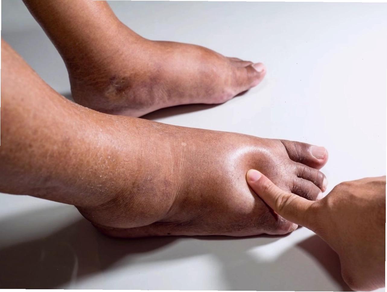 Hình ảnh mô tả triệu chứng sưng phù chân ở người trưởng thành