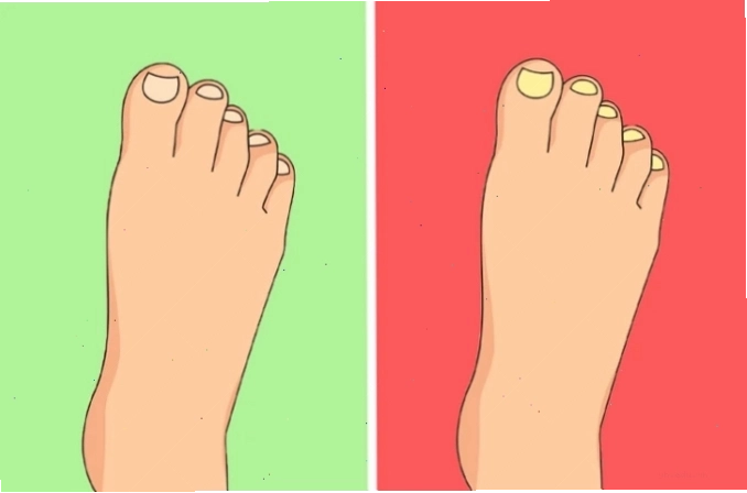 Hình ảnh móng chân bị dày và vàng