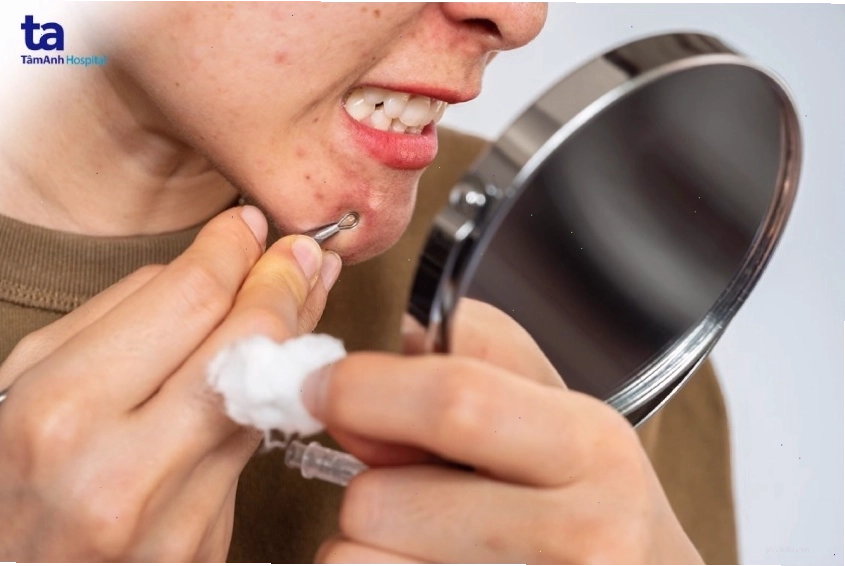 Hình ảnh mụn trứng cá đỏ dưới góc độ lâm sàng da liễu