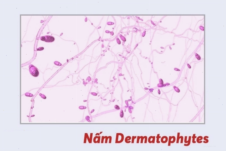 Hình ảnh nấm Dermatophytes gây bệnh nấm móng