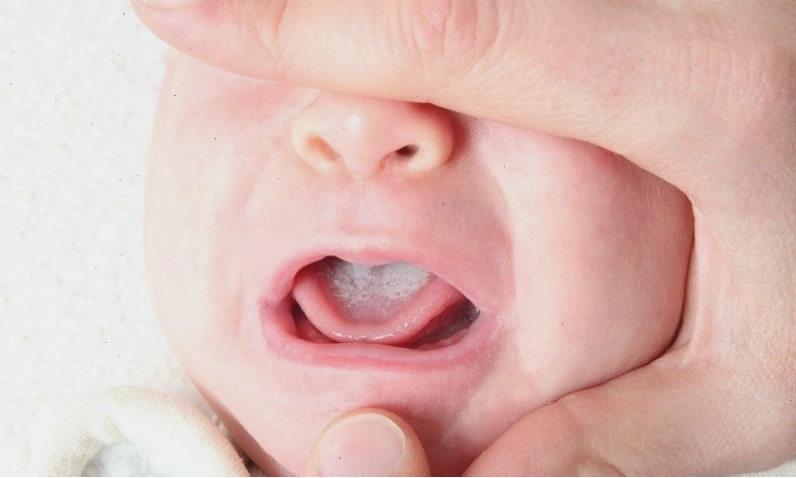 Hình ảnh nấm miệng gây mùi hôi