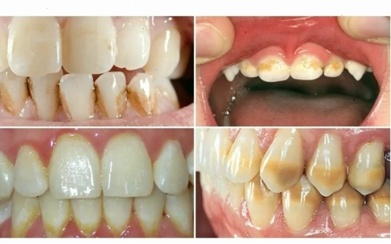 Hình ảnh nguyên nhân khiến chân răng bị vàng