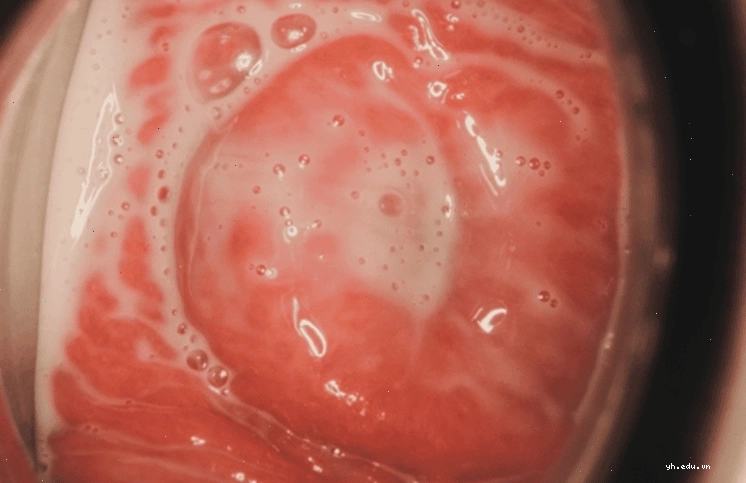 Hình ảnh nhiễm Trichomonas