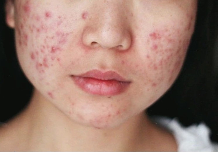 Hình ảnh nổi mụn trứng cá do thức khuya