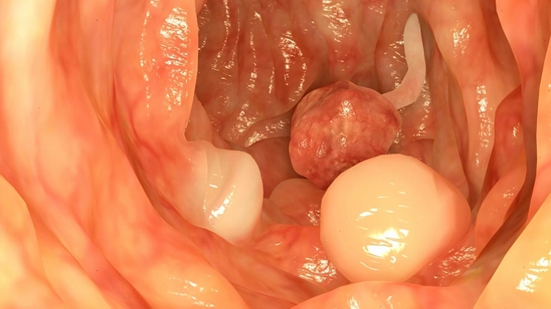 Hình ảnh nội soi polyp trong ống hậu môn