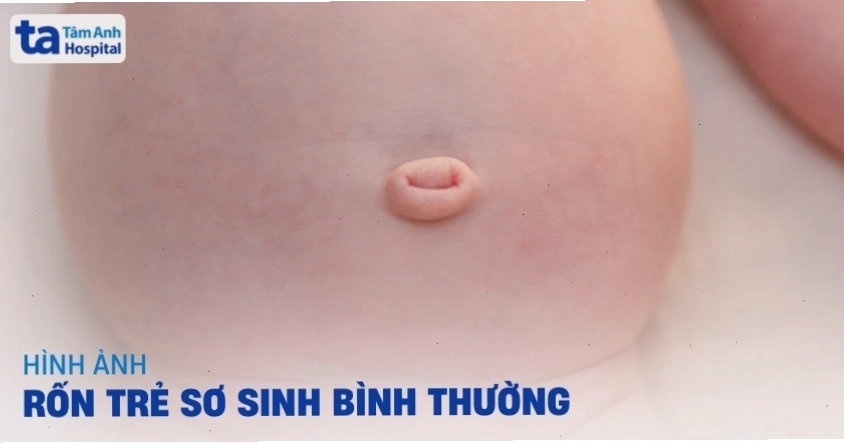 Hình ảnh rốn trẻ sơ sinh bình thường và bất thường hay gặp