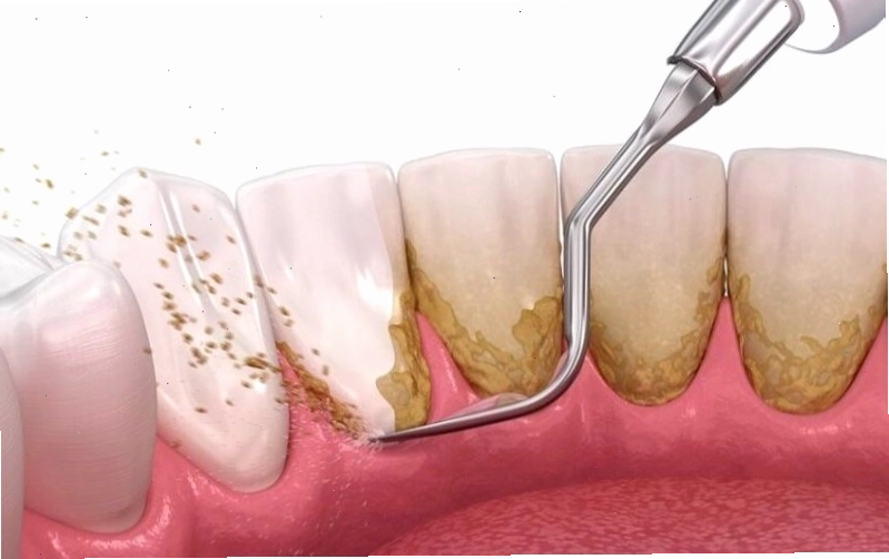 Hình ảnh thực hiện lấy cao răng
