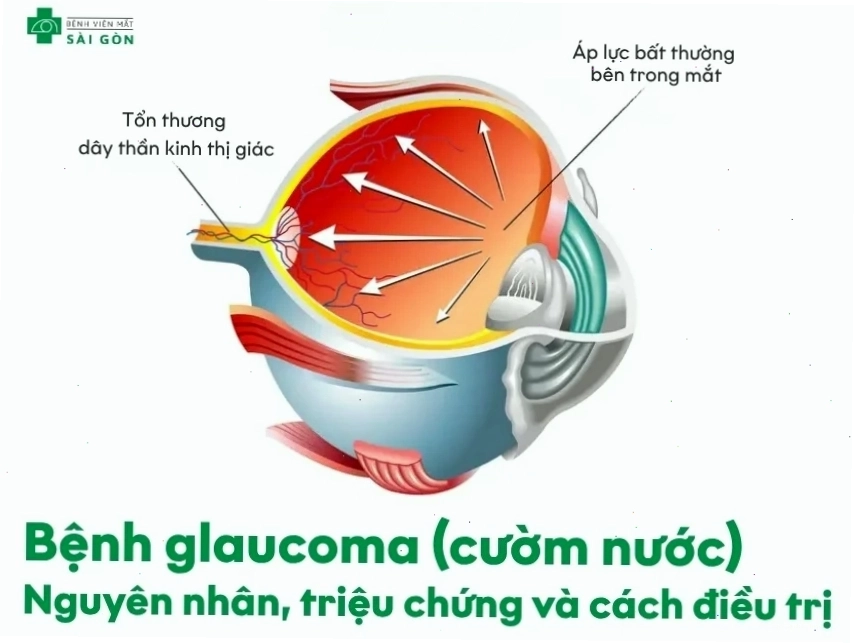 Hình ảnh tổng quan giải thích cơ chế bệnh glaucoma