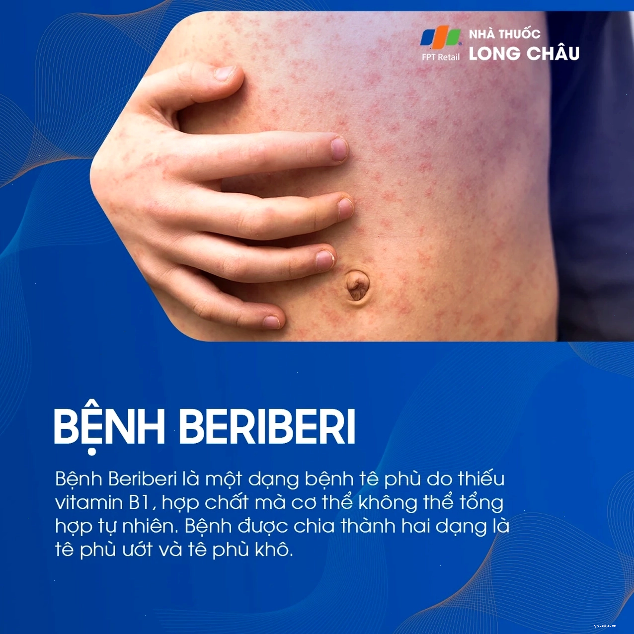 Hình ảnh tổng quan về tình trạng bệnh beriberi 1