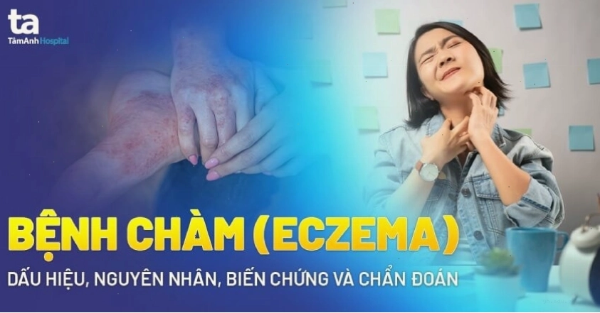 Hình ảnh tổng quan về tình trạng bệnh chàm trên da người
