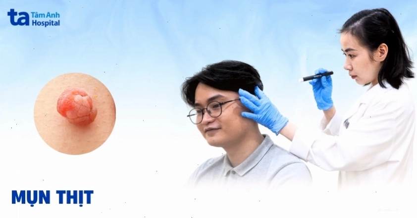 Hình ảnh tổng quan về tình trạng mụn thịt dư trên da