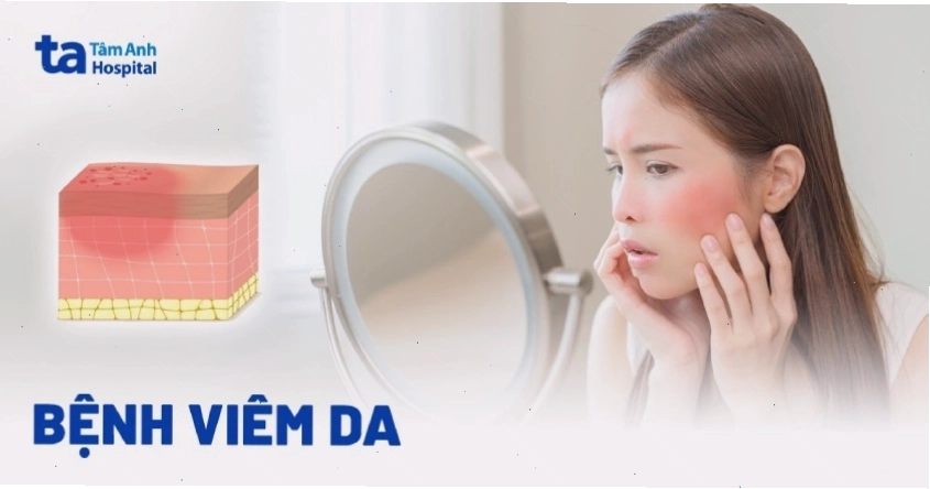Hình ảnh tổng quát về bệnh viêm da