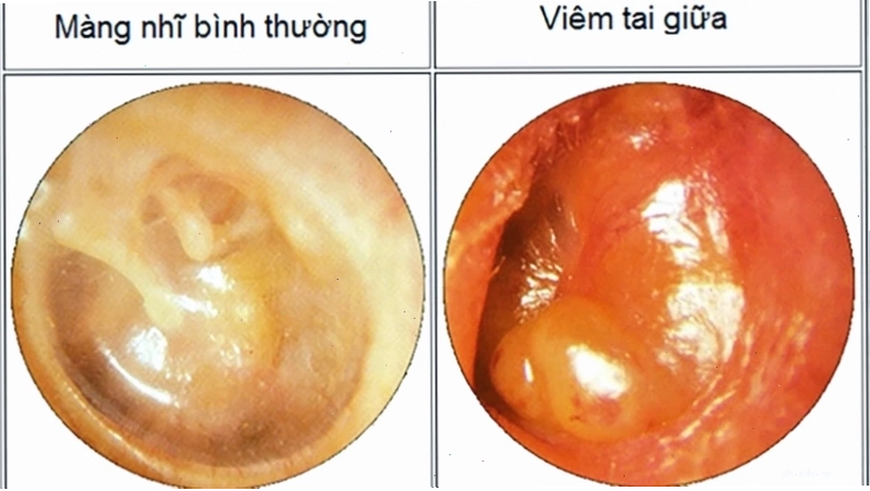 Hình ảnh triệu chứng viêm hô hấp thường gặp