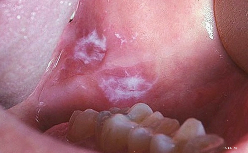 Hình ảnh trực quan về các đốm trắng trên lưỡi