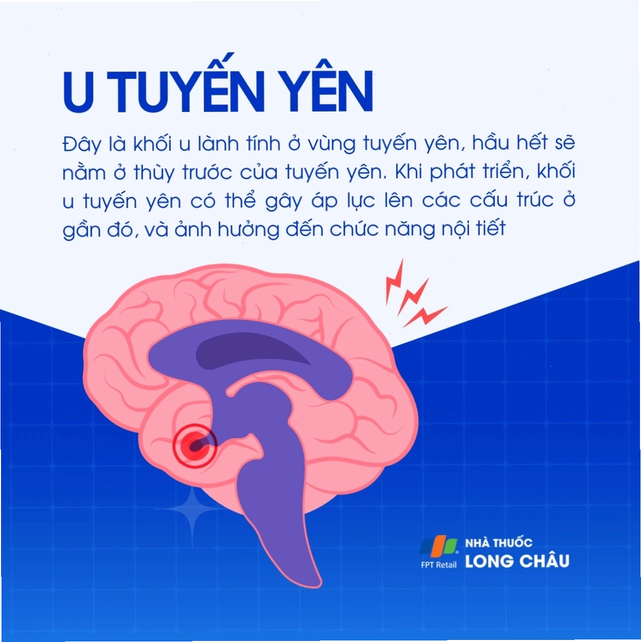 Hình ảnh u tuyến yên dạng 1