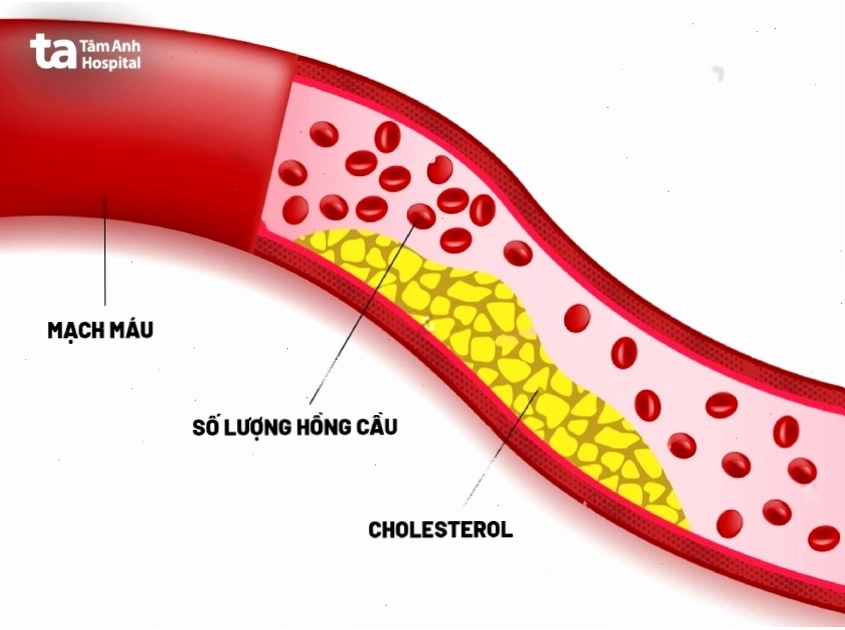 Hình ảnh về câu hỏi rối loạn mỡ máu có nguy hiểm không