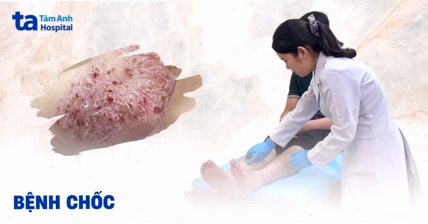 Hình ảnh vết thương do bệnh chốc gây ra trên da trẻ em