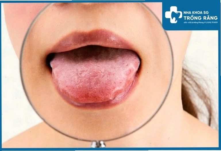 Hình ảnh viêm gai lưỡi thường gặp