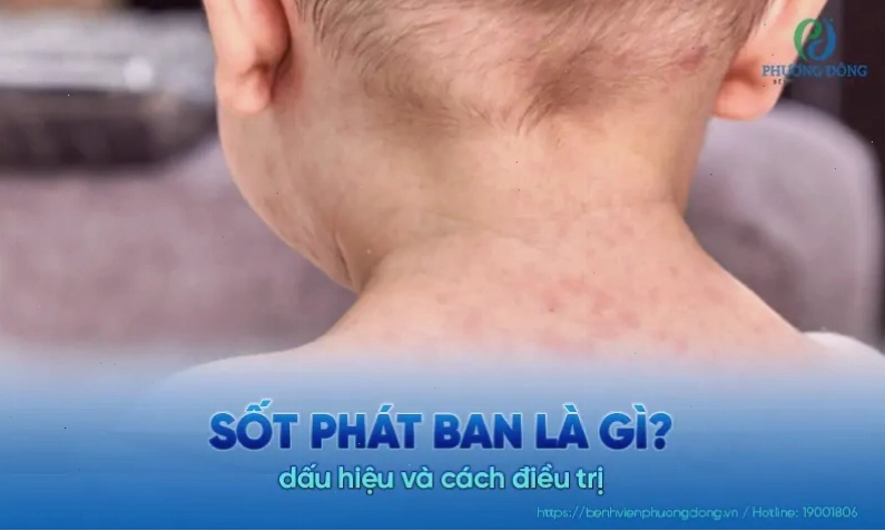 Hình minh họa bệnh sốt phát ban roseola ban đào ở trẻ nhỏ
