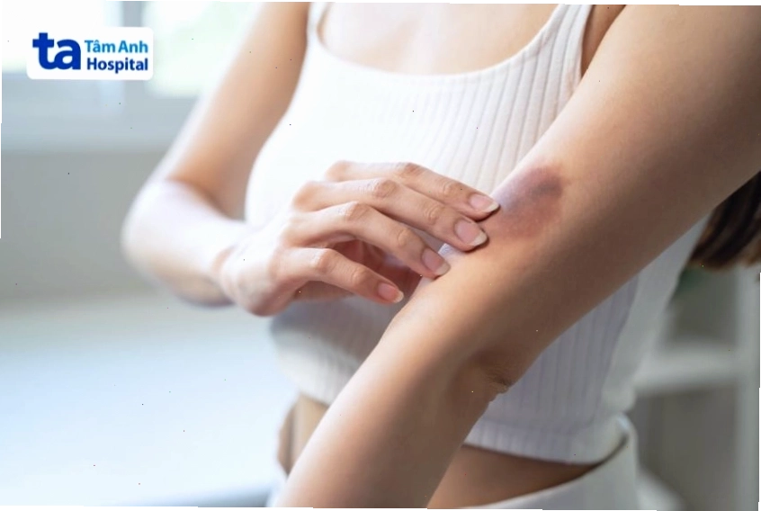 Hình minh họa vết bầm tím