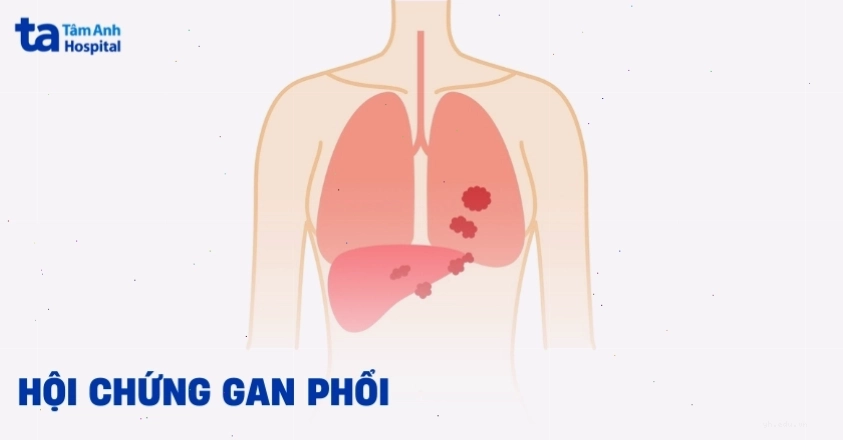Hội chứng gan phổi phát hiện như thế nào