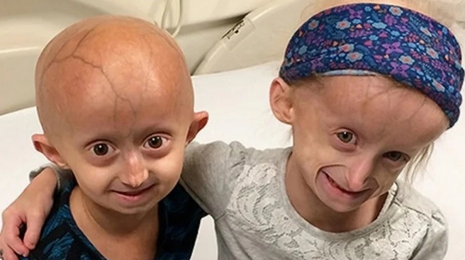 Hội chứng progeria là bệnh gì và các thông tin khoa học cần biết