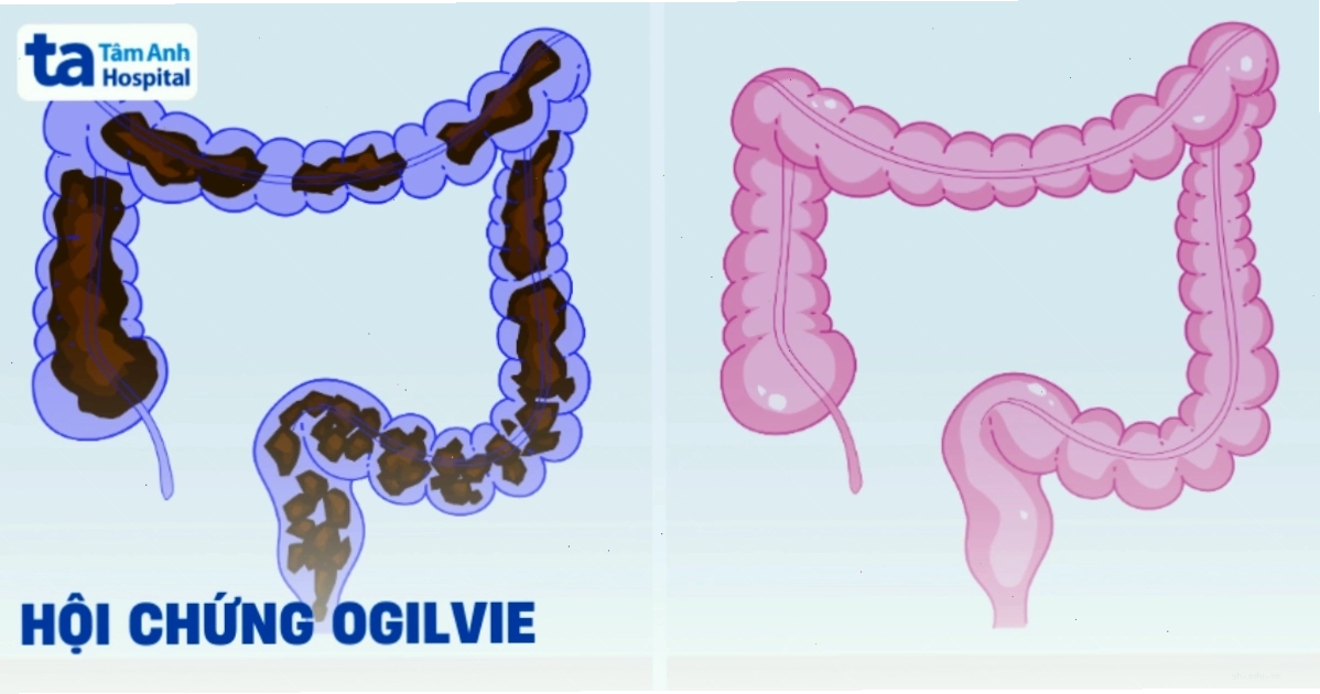 Hội chứng tắc ruột giả liên quan đến các vấn đề tiêu hóa
