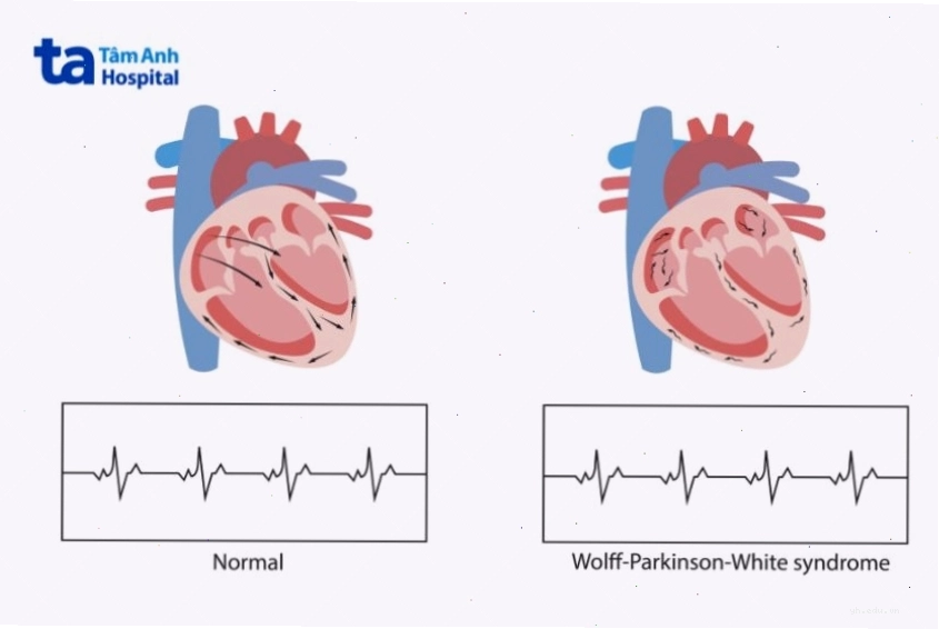 Hội chứng Wolff-Parkinson-White liên quan đến người mắc dị tật Ebstein