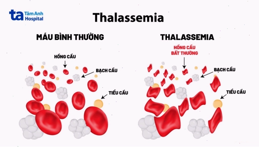 hồng cầu bất thường