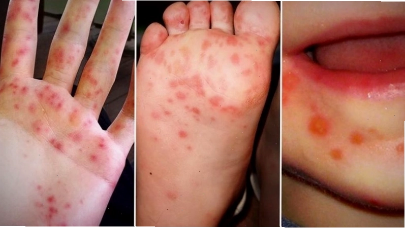Hướng dẫn vệ sinh phòng bệnh tay chân miệng