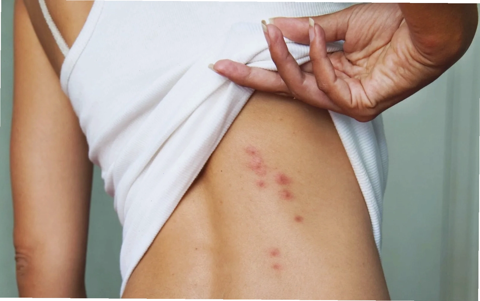 Hướng dẫn vệ sinh vùng da bị côn trùng cắn