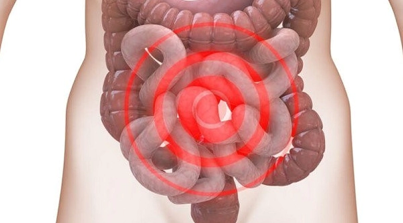IBS là bệnh gì và những lưu ý quan trọng để kiểm soát hội chứng này